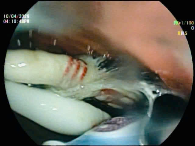 Bệnh viện Trung ương Huế: Kịp thời cứu sống bệnh nhân nuốt 3 bàn chải răng- Ảnh 2.