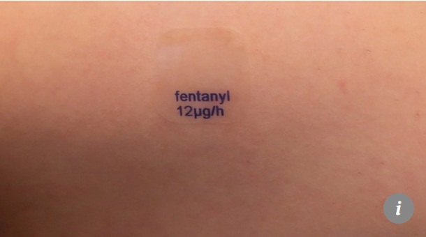 Miếng dán giảm đau fentanyl.