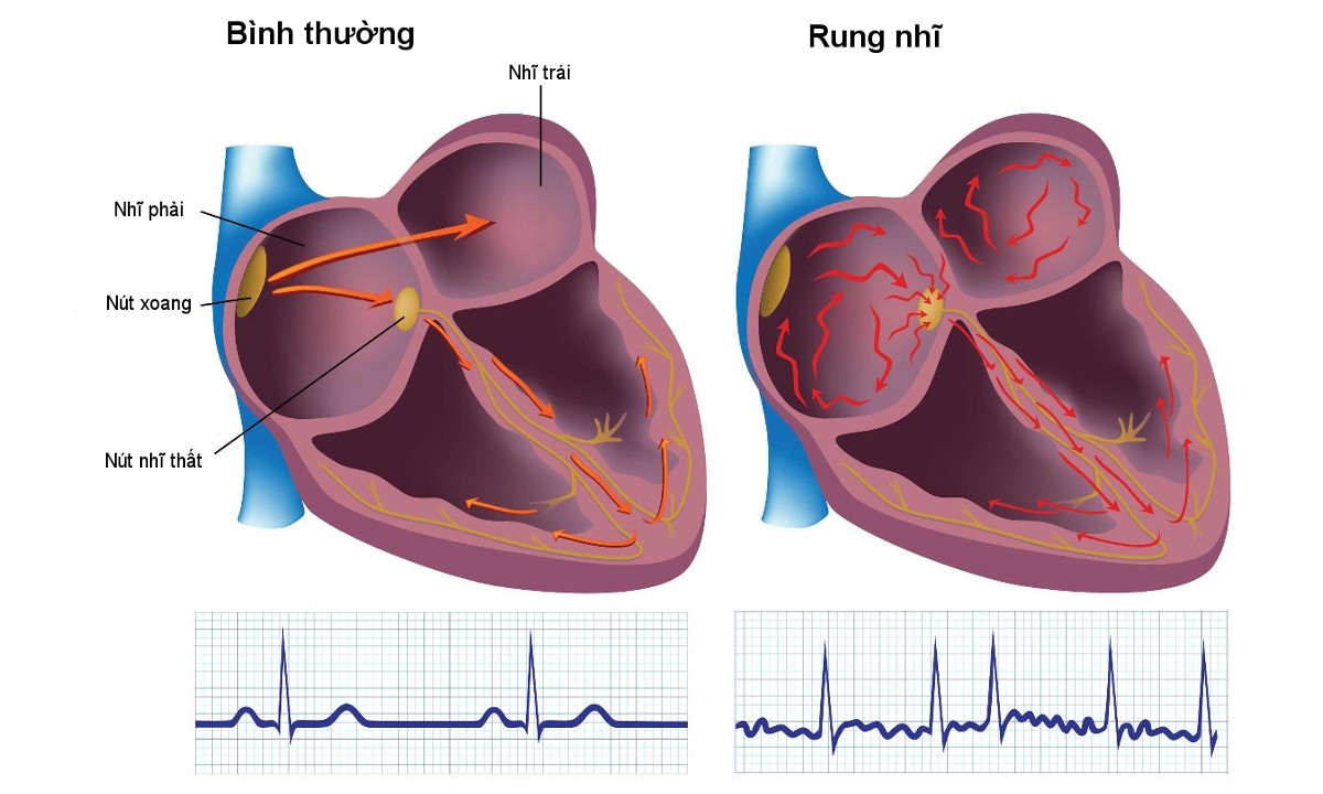 Tuổi cao, tăng huyết áp, suy tim sung huyết và bệnh van hai lá là những nguyên nhân gây ra bệnh rung nhĩ