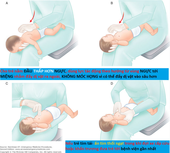 Thực hiện đúng cách xử trí khi trẻ hóc dị vật sẽ hạn chế được những tai biến đối với trẻ.