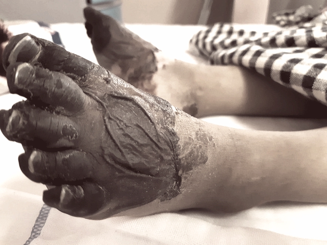  Bàn chân của một bé gái bị nhiễm khuẩn huyết không rõ nguyên nhân, buộc phải cắt bỏ để bảo toàn tính mạng. 
