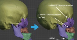 Điều trị khớp cắn ngược do xương hàm – Góc nhìn chuyên sâu từ TS.BS Đồng Ngọc Quang