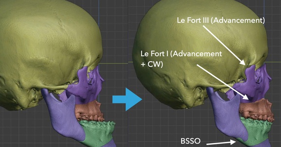 Điều trị khớp cắn ngược do xương hàm – Góc nhìn chuyên sâu từ TS.BS Đồng Ngọc Quang